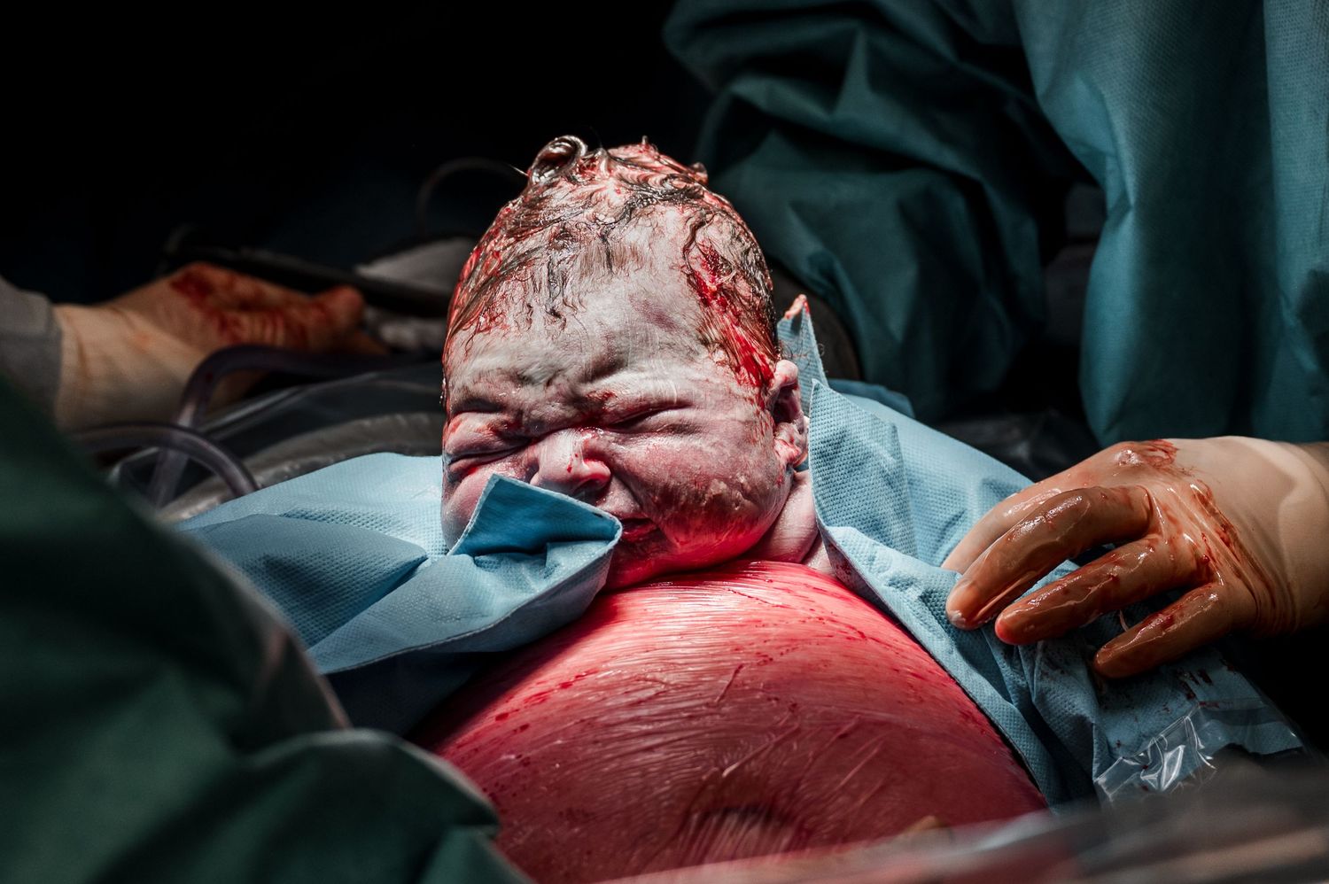 A newborn baby emerges during a cesarean section delivery under bright surgical lights.