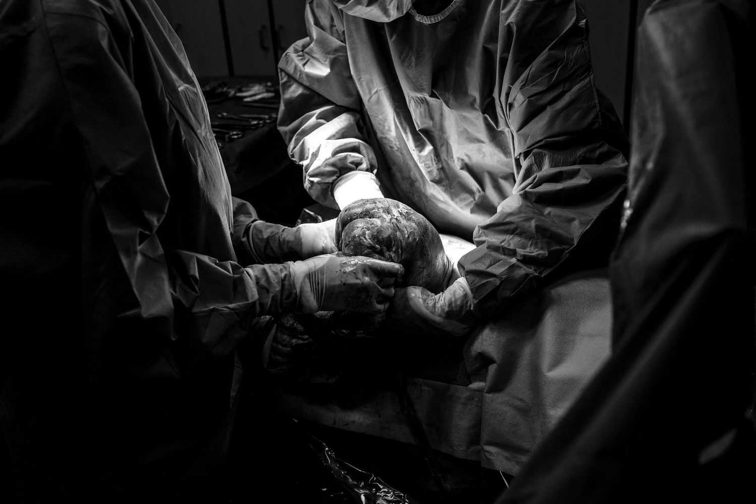 A surgical team performs an operation in a dimly lit operating room, captured in dramatic black and white.