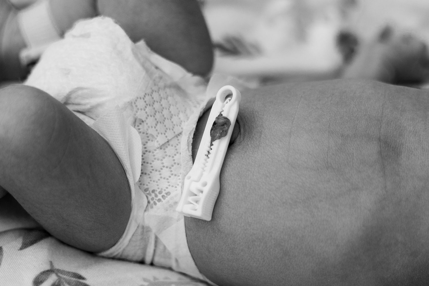 Close-up detail of unbiblical cord on infant after birth.