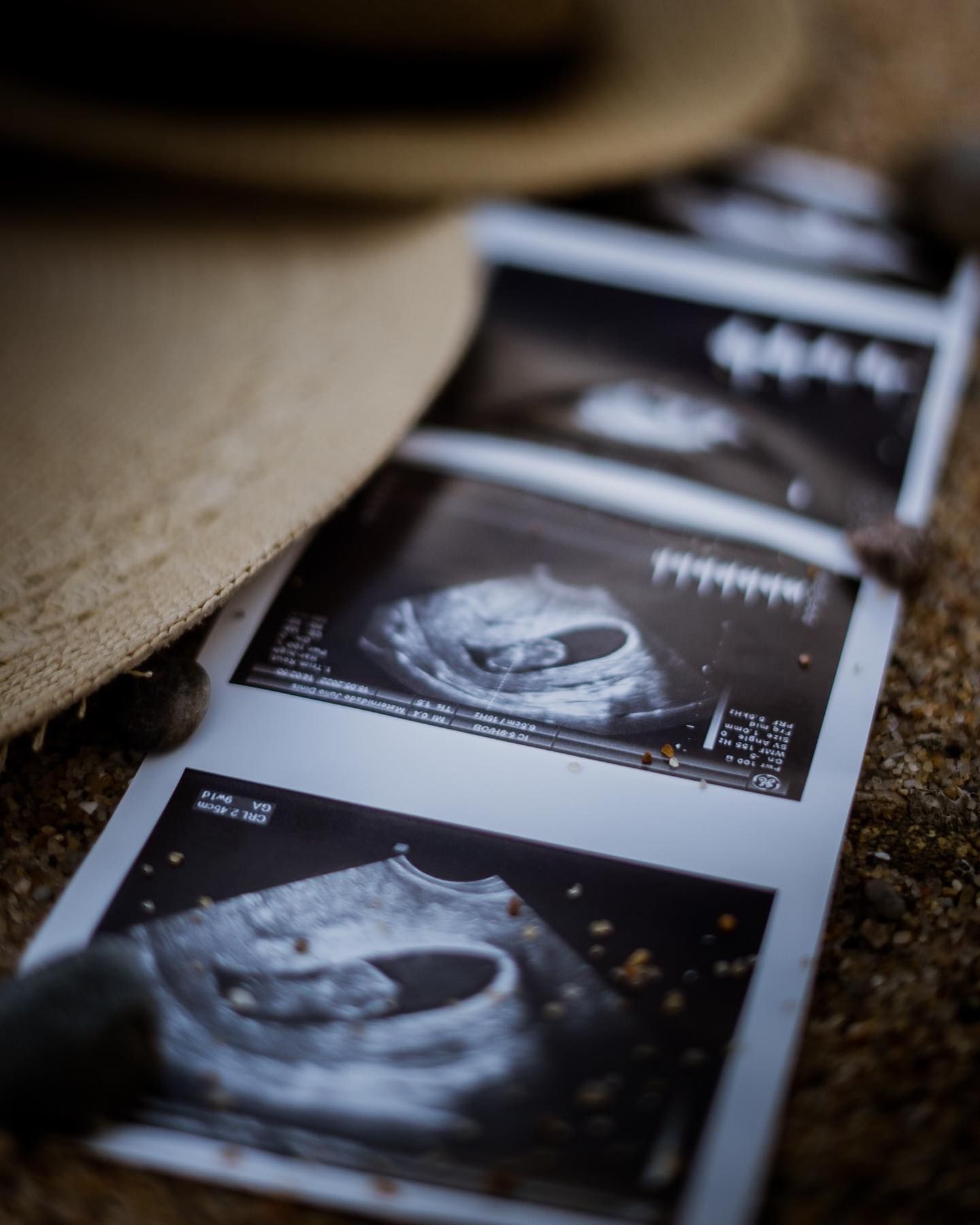 A strip of four ultrasound photos rests on a rocky surface near a straw hat at the beach.