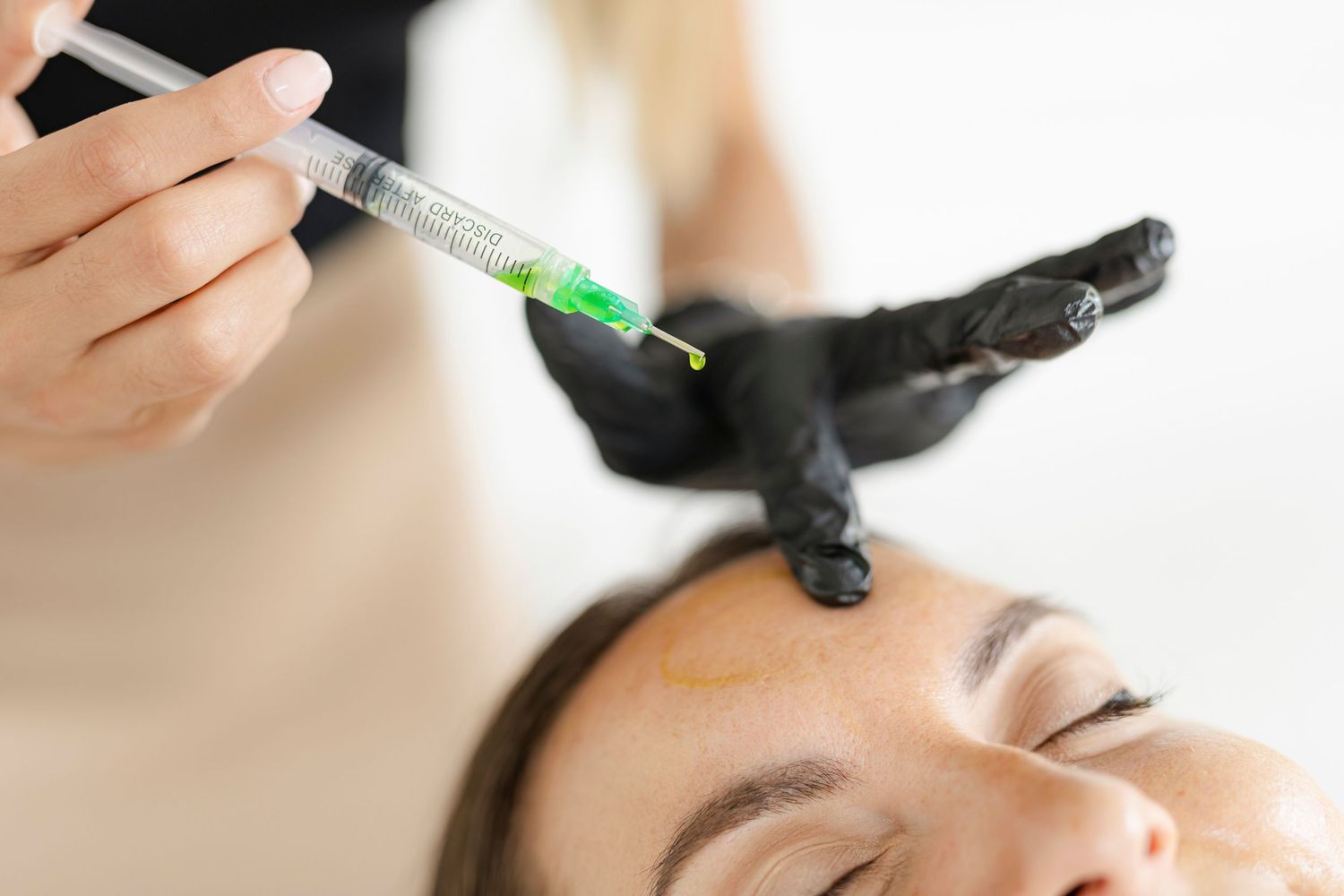 Closeup of cosmetic enhancement treatment showing injection syringe with clear liquid during a beauty procedure.