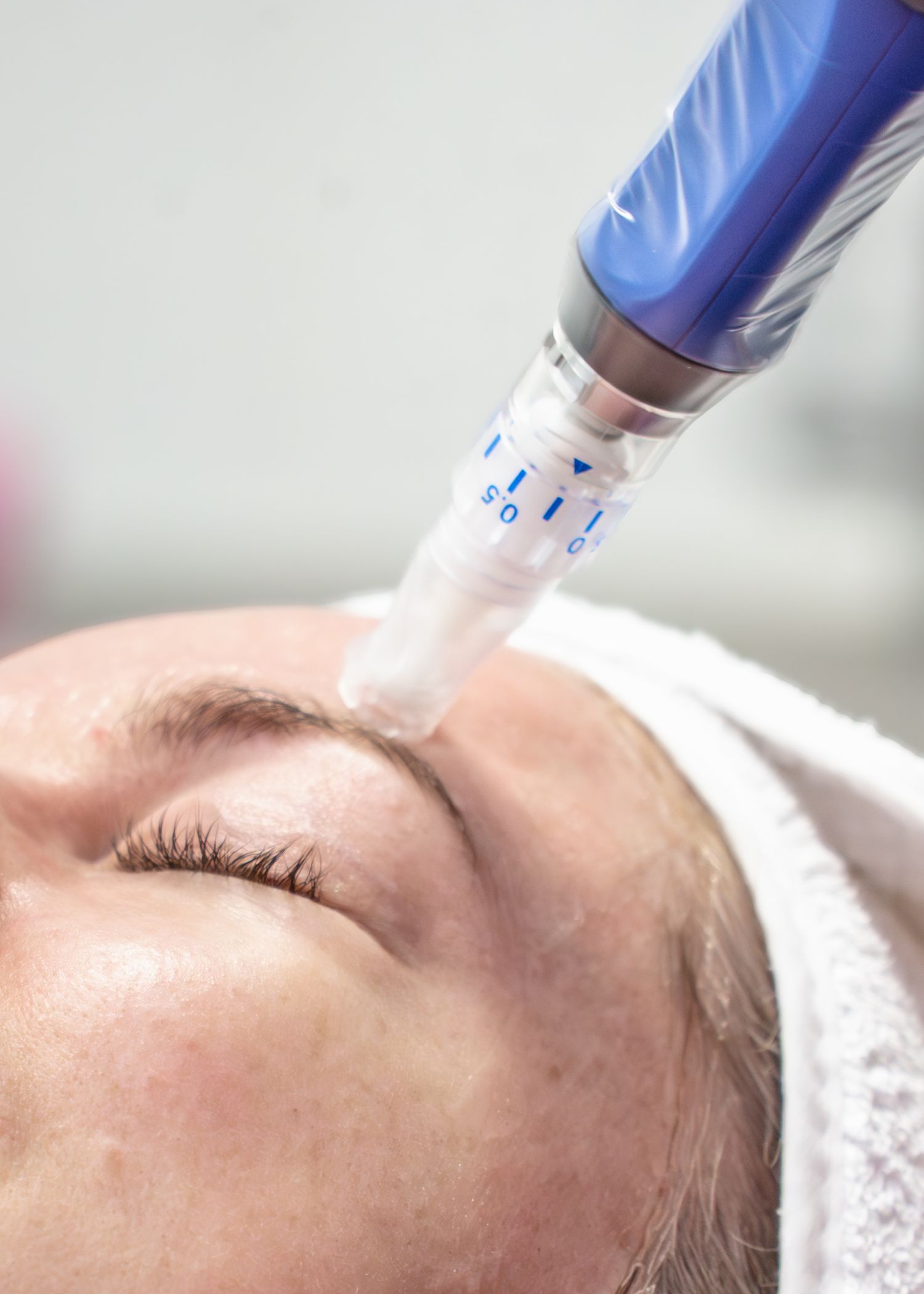 A medical professional performs a cosmetic treatment using a blue pen-like device on a patient's face.