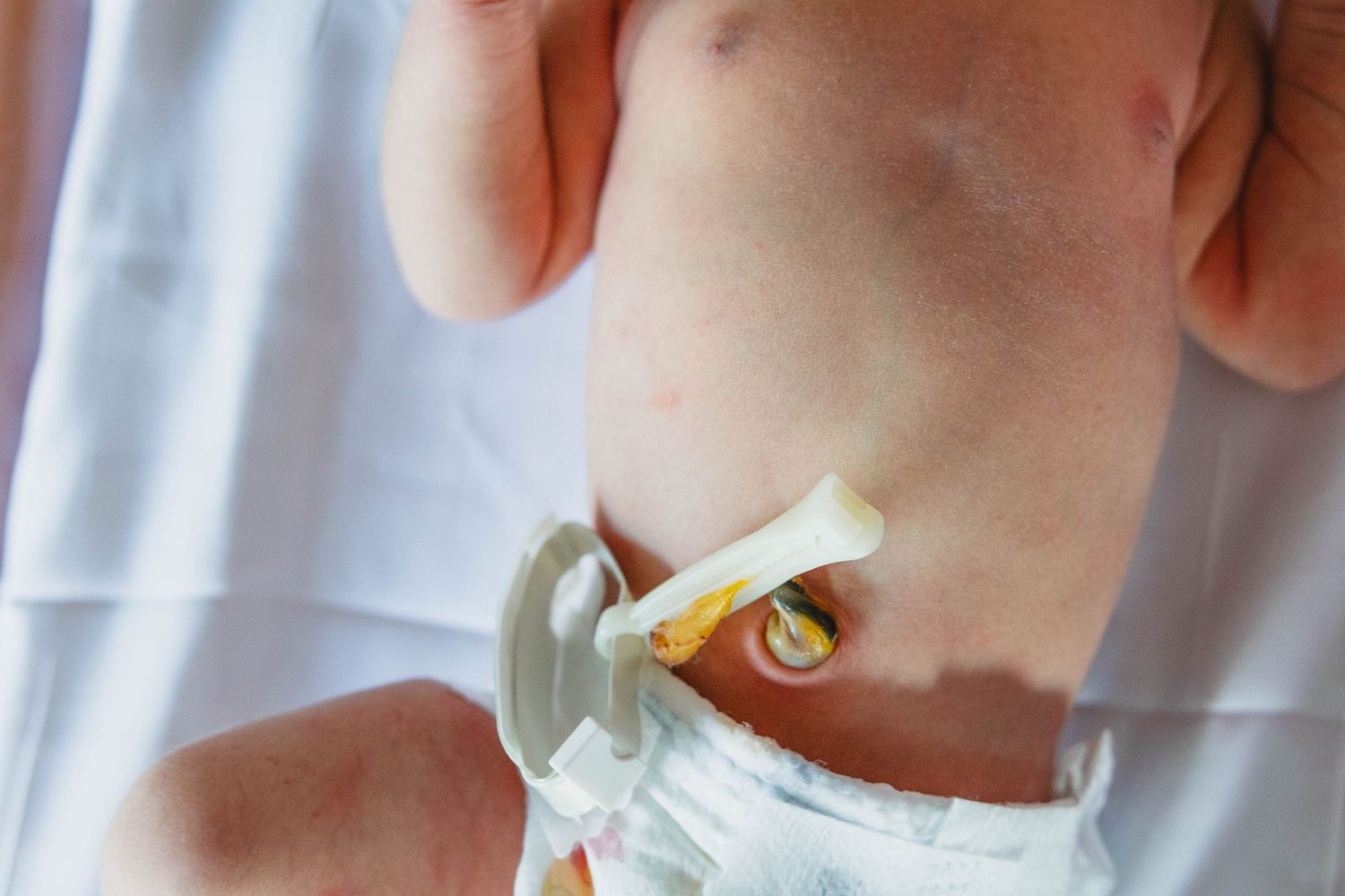 Close-up of newborn baby belly with umbilical cord clamp in hospital diaper.