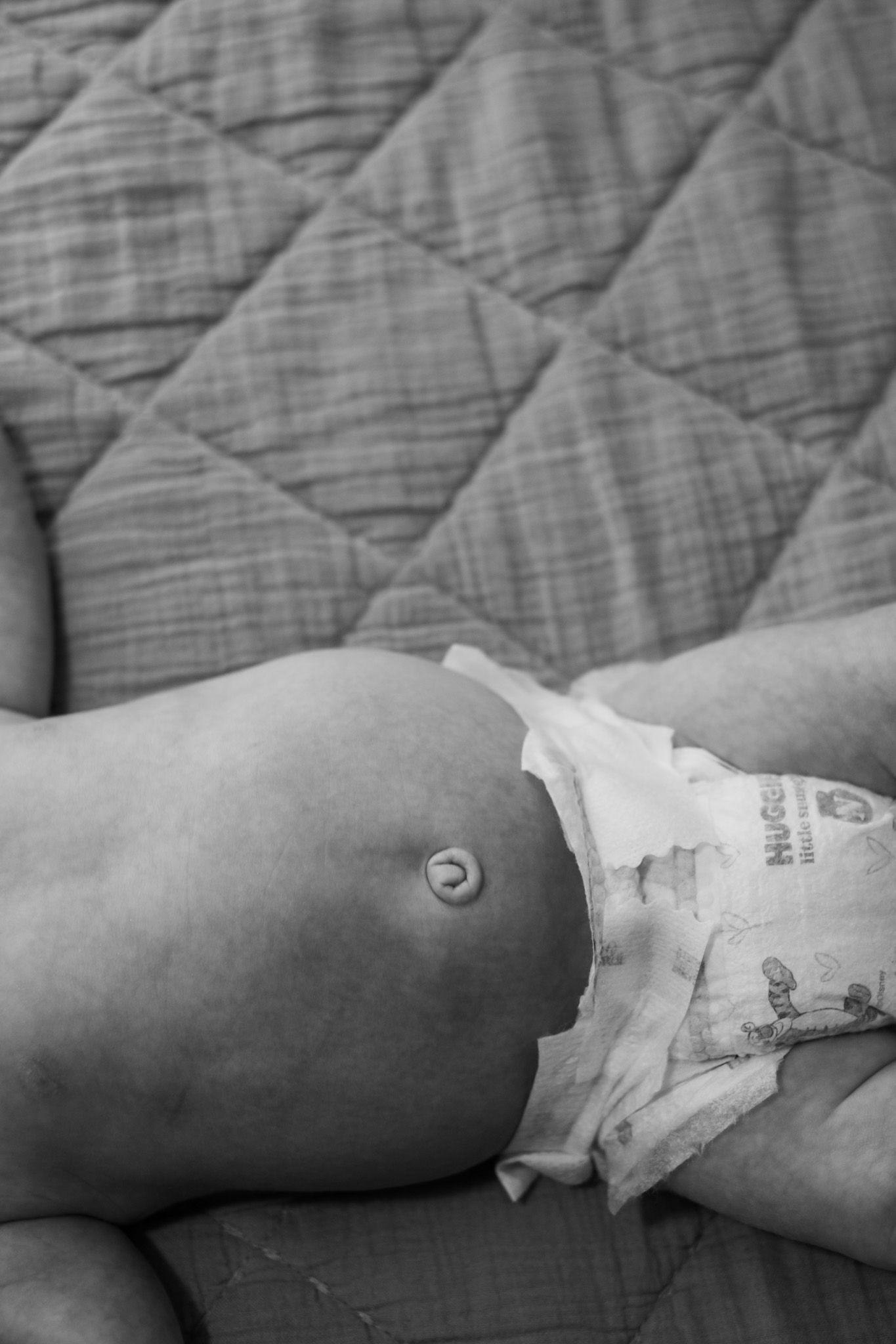 Medical detail shot showing bandaged arm against quilted background.